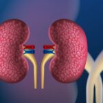 kidney-stone-blog